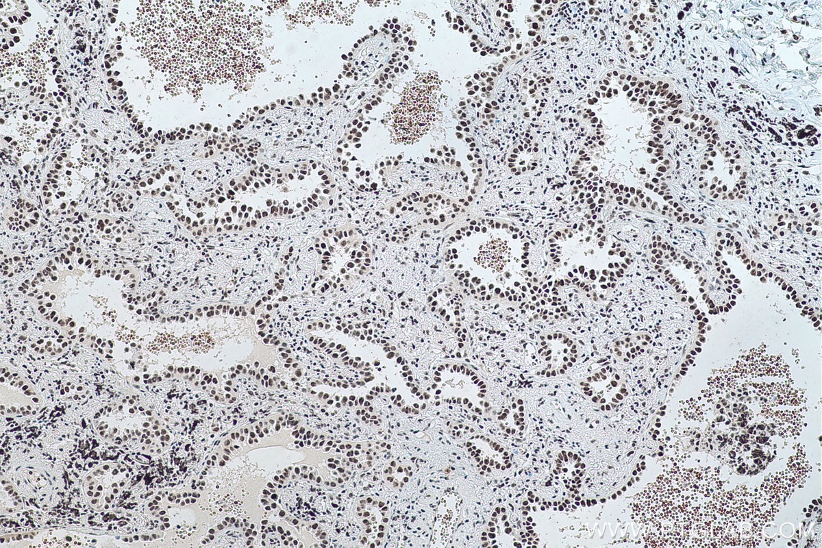 Immunohistochemical analysis of paraffin-embedded human lung cancer tissue slide using KHC0497 (RBM39 IHC Kit).