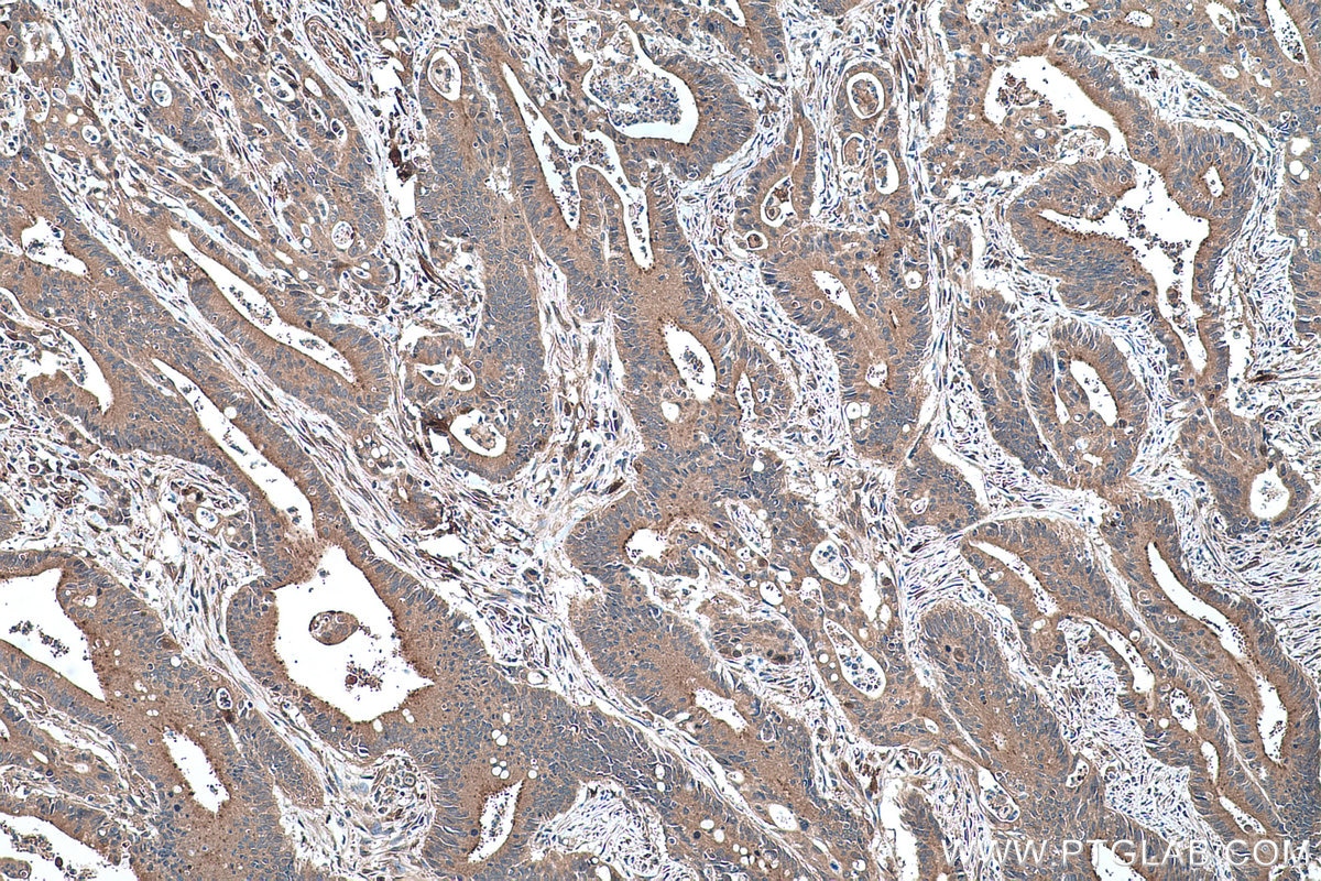 Immunohistochemical analysis of paraffin-embedded human colon cancer tissue slide using KHC0453 (RBP1 IHC Kit).
