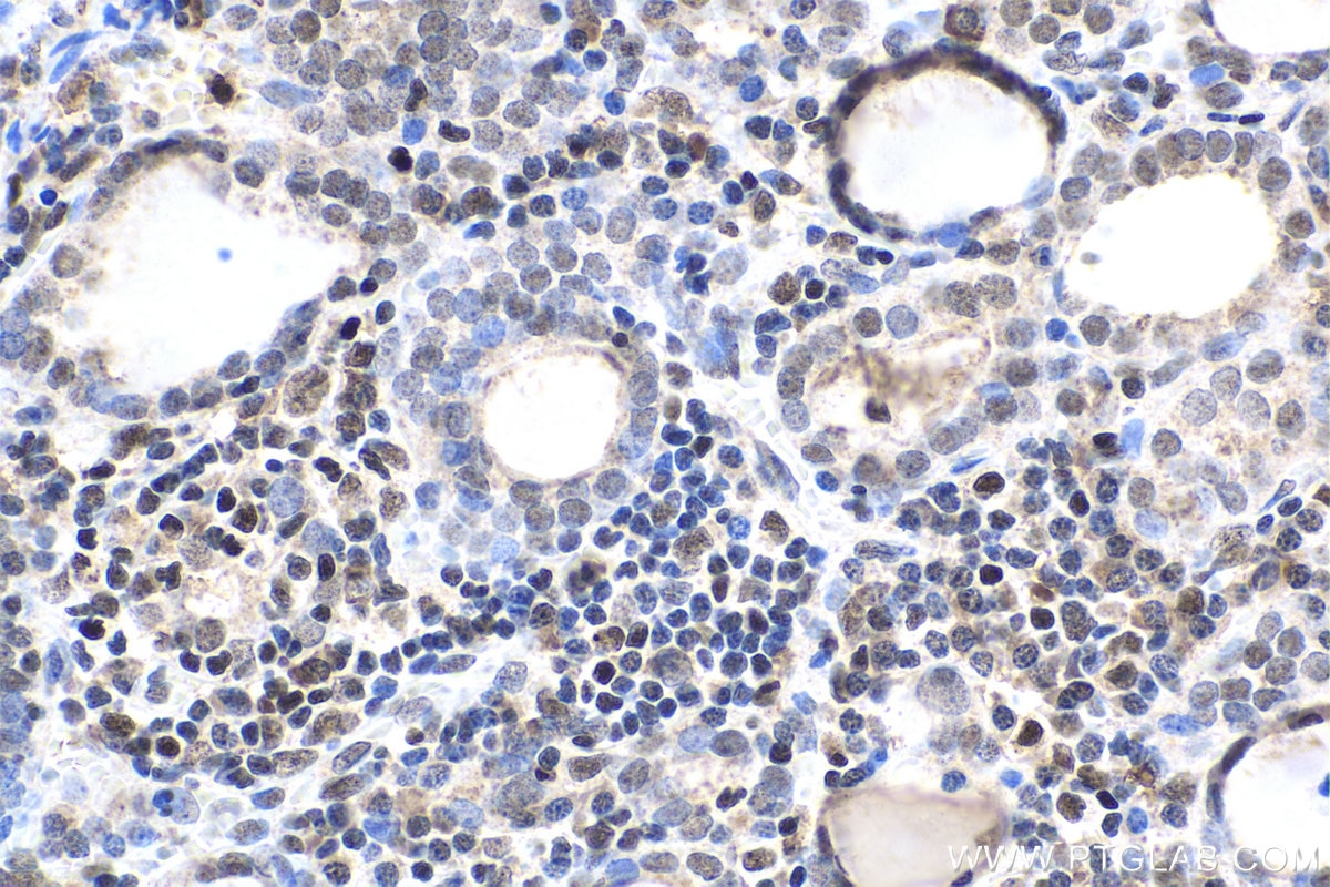 Immunohistochemical analysis of paraffin-embedded human thyroid cancer tissue slide using KHC1679 (RBPJ IHC Kit).