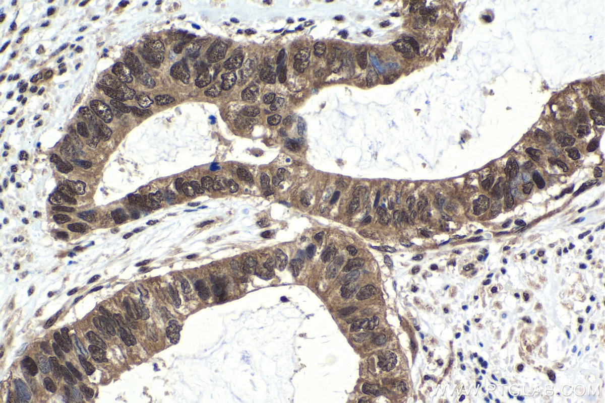 Immunohistochemical analysis of paraffin-embedded human urothelial carcinoma tissue slide using KHC1648 (RBX1 IHC Kit).