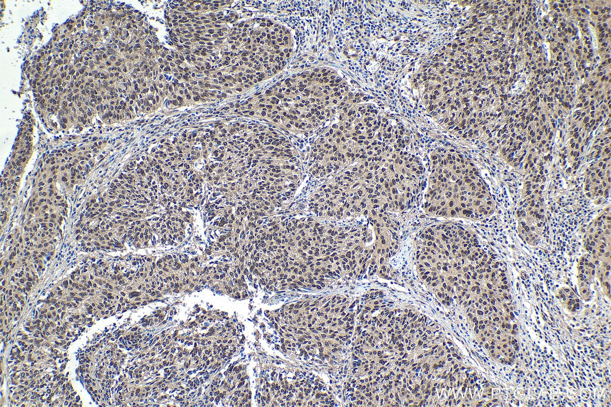 Immunohistochemical analysis of paraffin-embedded human cervical cancer tissue slide using KHC1648 (RBX1 IHC Kit).