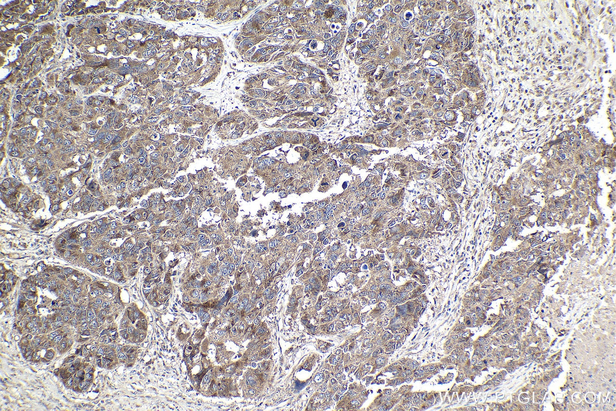 Immunohistochemical analysis of paraffin-embedded human ovary cancer tissue slide using KHC2050 (RCAS1 IHC Kit).
