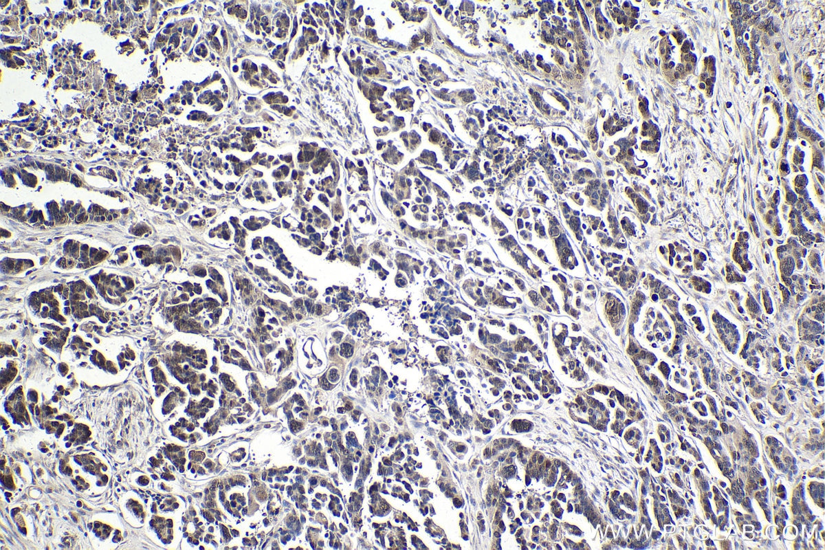 Immunohistochemical analysis of paraffin-embedded human colon cancer tissue slide using KHC1015 (RCC2 IHC Kit).