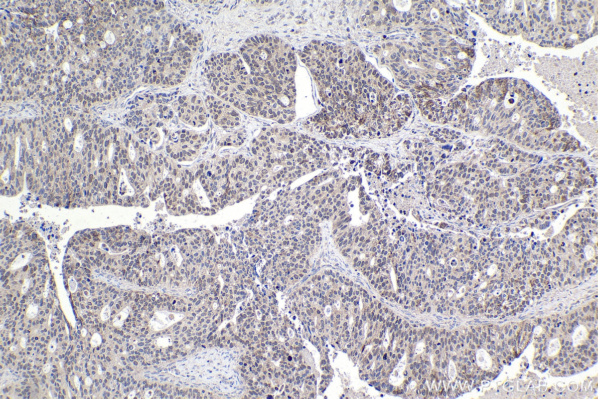 Immunohistochemical analysis of paraffin-embedded human ovary tumor tissue slide using KHC1015 (RCC2 IHC Kit).