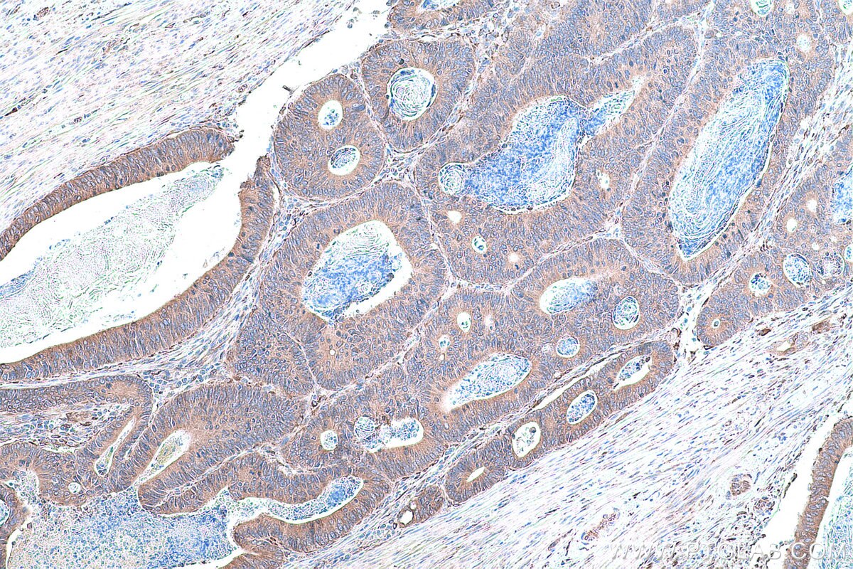 Immunohistochemical analysis of paraffin-embedded human colon cancer tissue slide using KHC0862 (RCN2 IHC Kit).