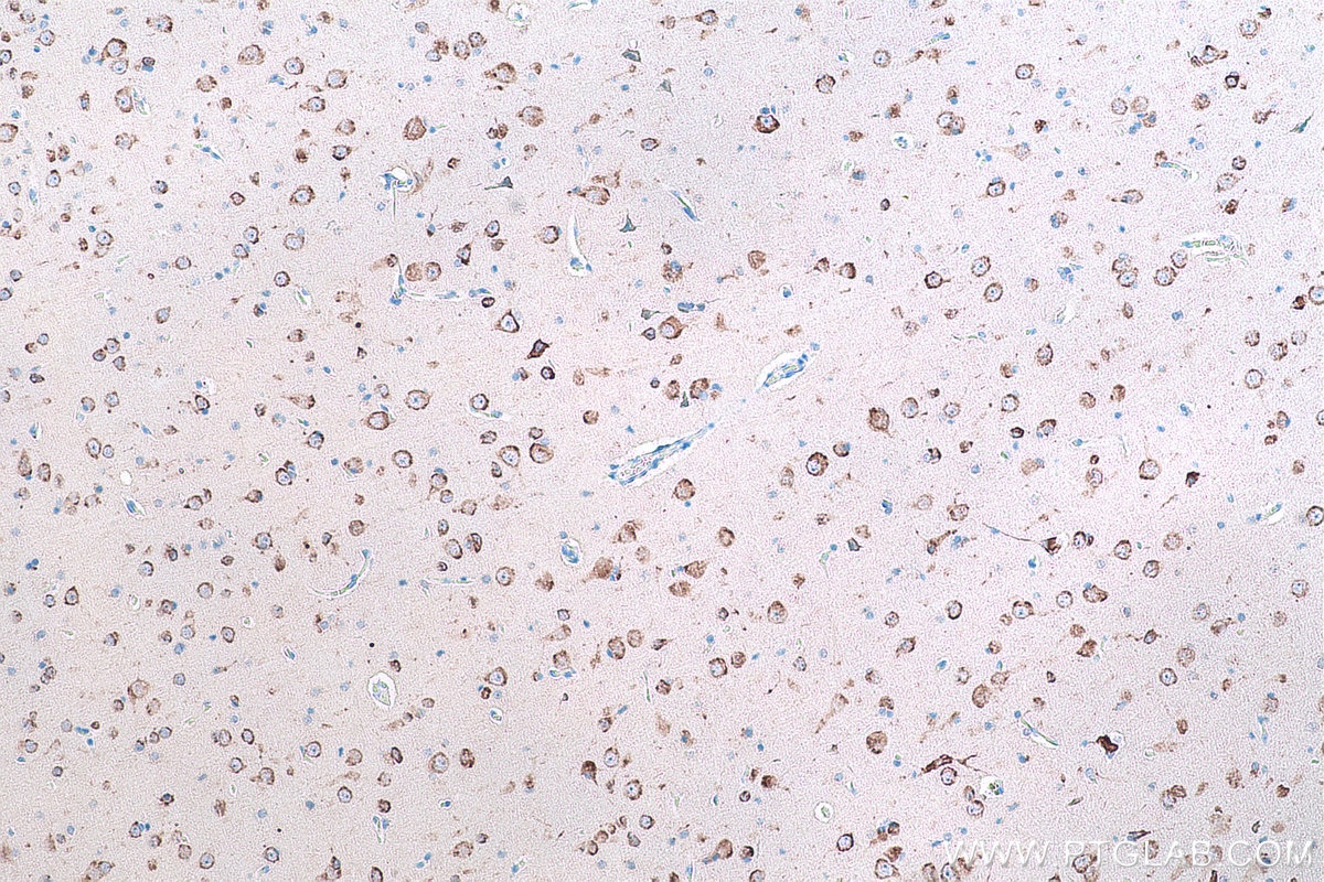 Immunohistochemical analysis of paraffin-embedded human gliomas tissue slide using KHC0862 (RCN2 IHC Kit).