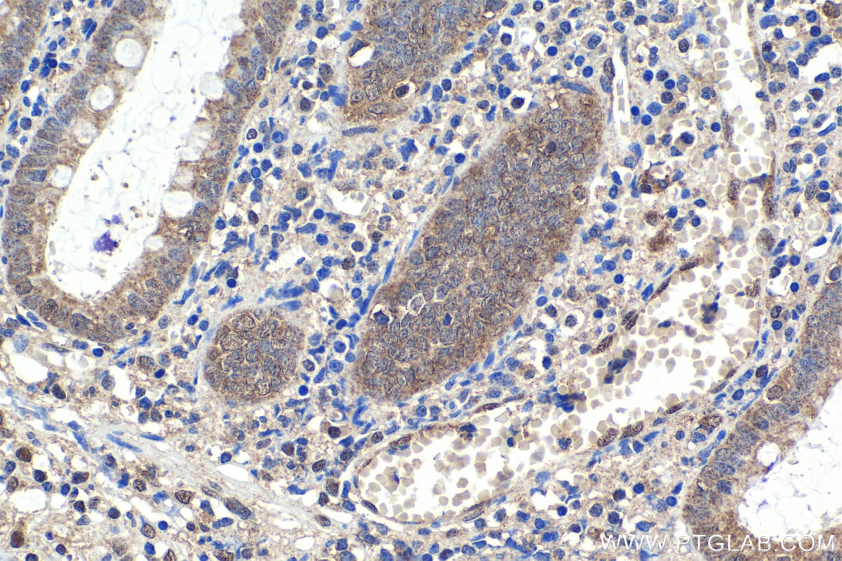 Immunohistochemical analysis of paraffin-embedded human appendicitis tissue slide using KHC1664 (RELB IHC Kit).