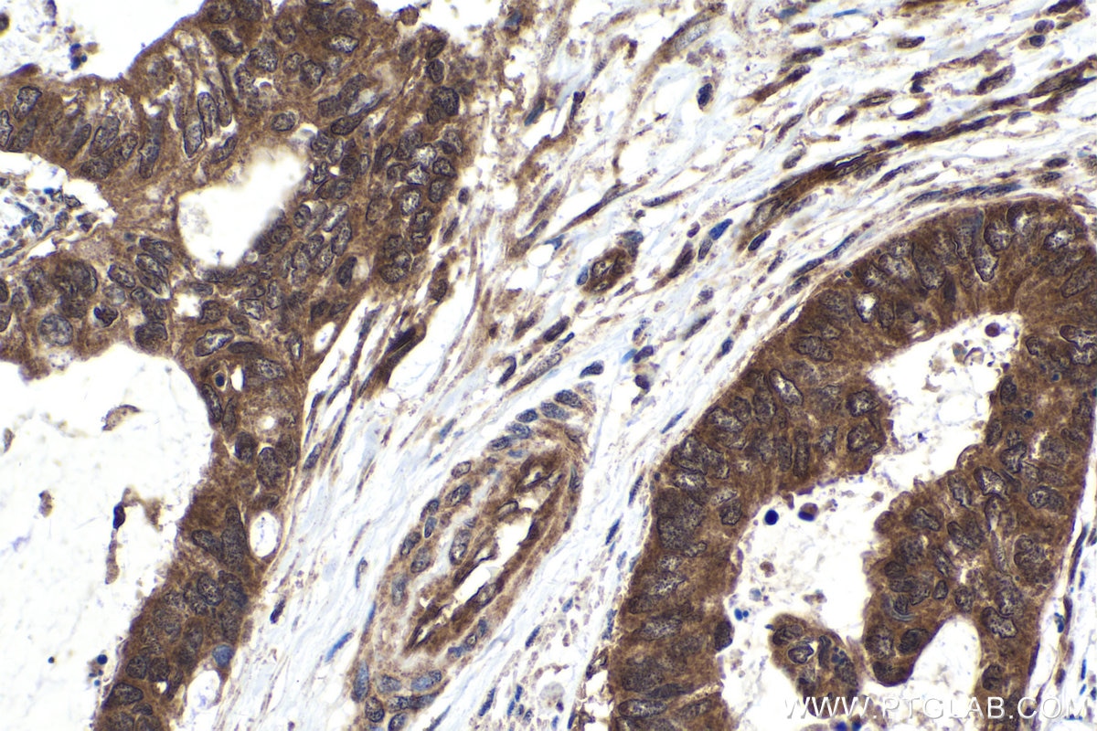 Immunohistochemical analysis of paraffin-embedded human urothelial carcinoma tissue slide using KHC1664 (RELB IHC Kit).