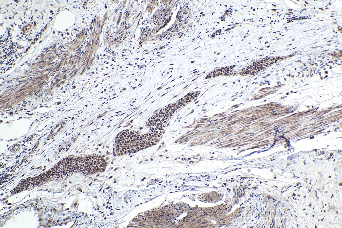 Immunohistochemical analysis of paraffin-embedded human urothelial carcinoma tissue slide using KHC1701 (REST IHC Kit).