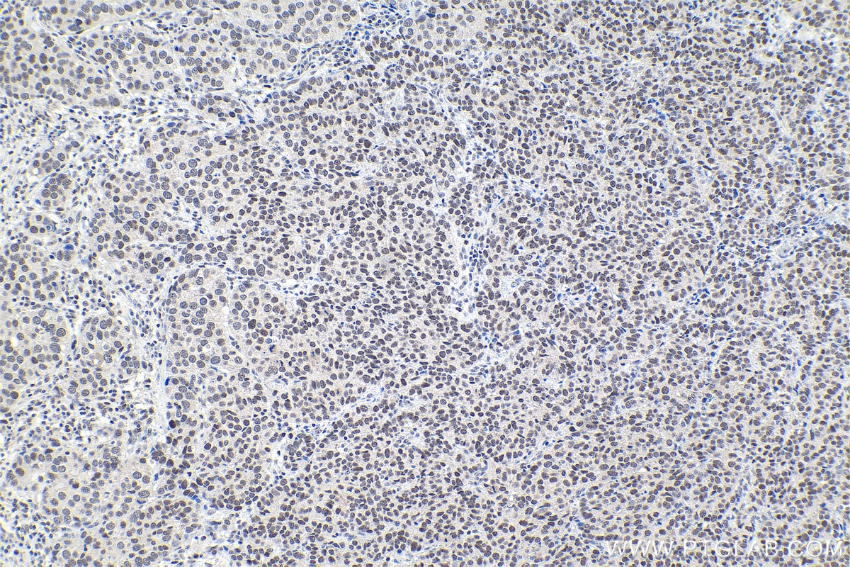 Immunohistochemical analysis of paraffin-embedded human stomach cancer tissue slide using KHC1610 (RFX5 IHC Kit).