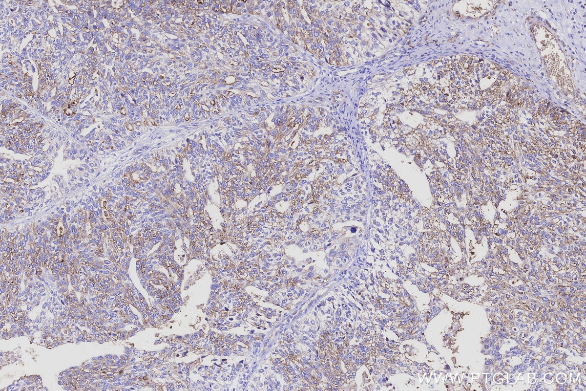 Immunohistochemical analysis of paraffin-embedded human ovary cancer tissue slide using KHC3113 (RGPD5 IHC Kit).