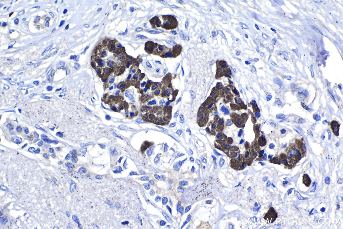 Immunohistochemical analysis of paraffin-embedded human pancreas cancer tissue slide using KHC1405 (RGS6 IHC Kit).