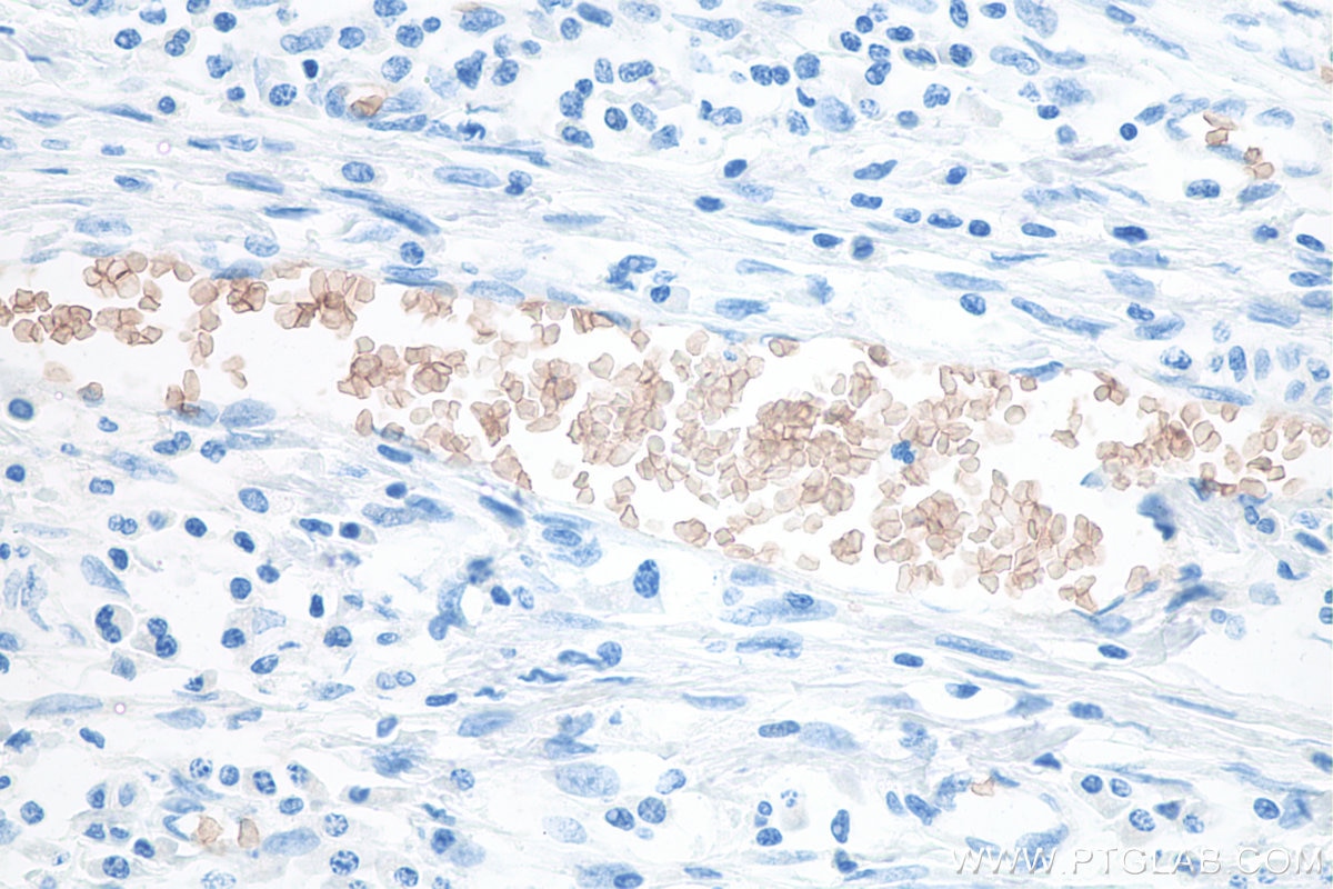 Immunohistochemical analysis of paraffin-embedded human colon cancer tissue slide using KHC0075 (RHAG IHC Kit).