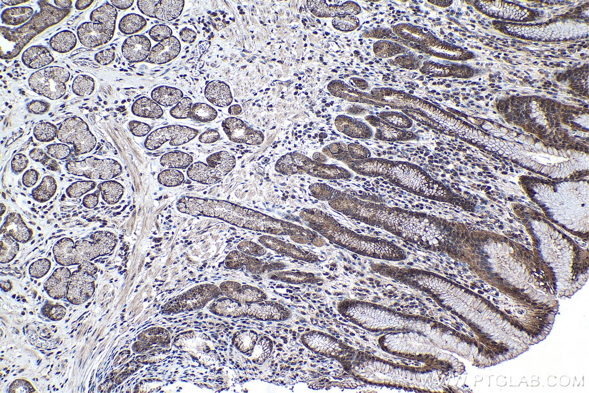 Immunohistochemical analysis of paraffin-embedded human stomach cancer tissue slide using KHC1049 (RHEB IHC Kit).