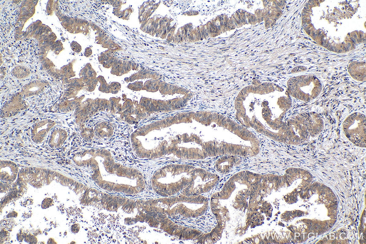 Immunohistochemical analysis of paraffin-embedded human pancreas cancer tissue slide using KHC1049 (RHEB IHC Kit).