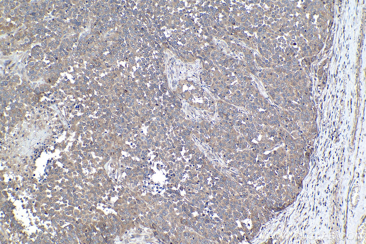 Immunohistochemical analysis of paraffin-embedded human ovary tumor tissue slide using KHC1049 (RHEB IHC Kit).