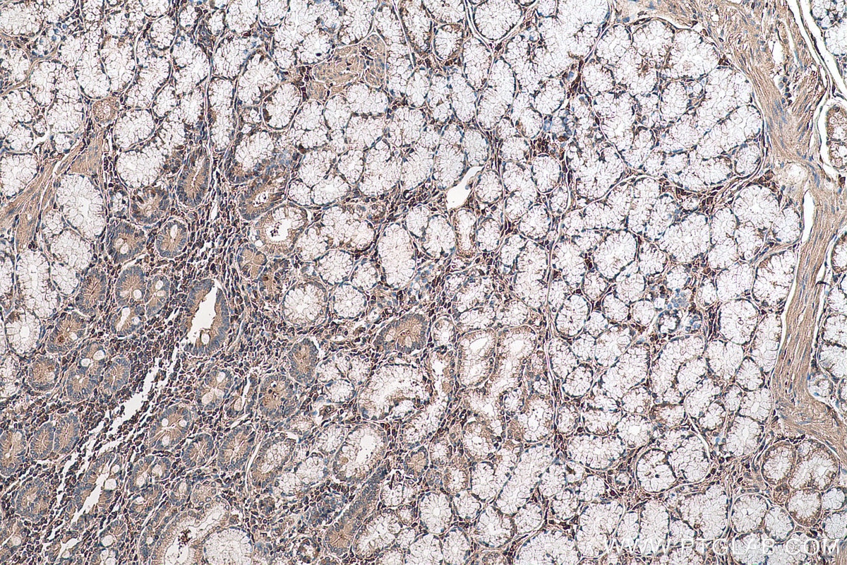 Immunohistochemical analysis of paraffin-embedded human stomach cancer tissue slide using KHC0638 (RHOA IHC Kit).