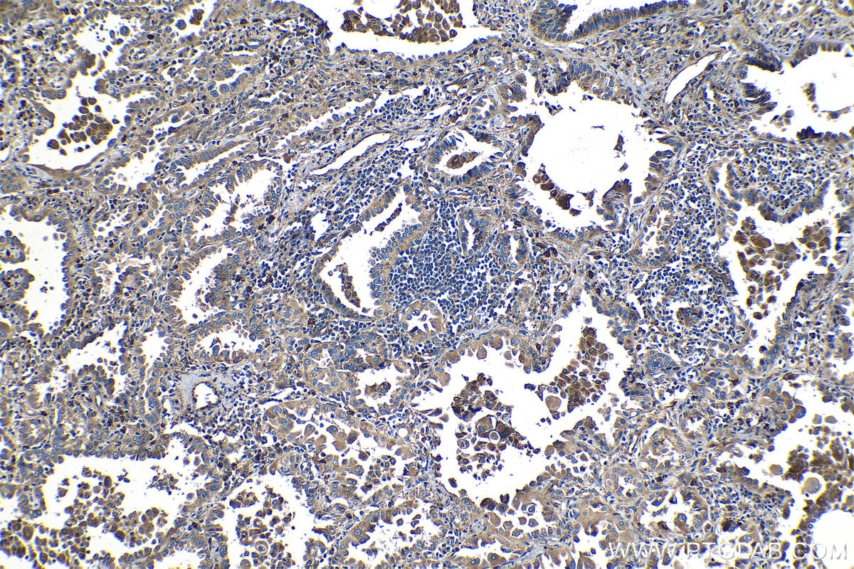 Immunohistochemical analysis of paraffin-embedded human lung cancer tissue slide using KHC1256 (RIBC2 IHC Kit).