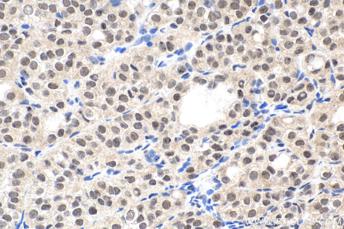 Immunohistochemical analysis of paraffin-embedded human thyroid cancer tissue slide using KHC1780 (RIF1 IHC Kit).