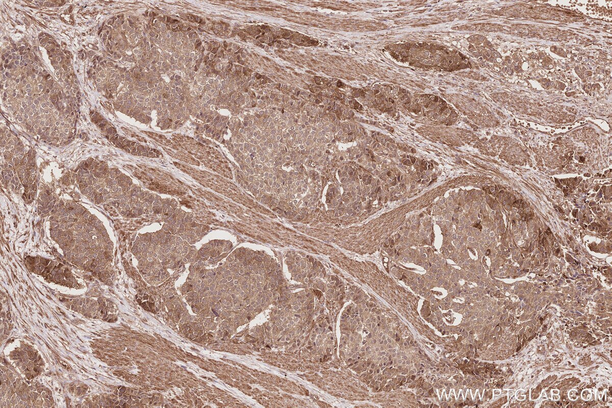 Immunohistochemical analysis of paraffin-embedded human stomach cancer tissue slide using KHC2858 (RIOK1 IHC Kit).