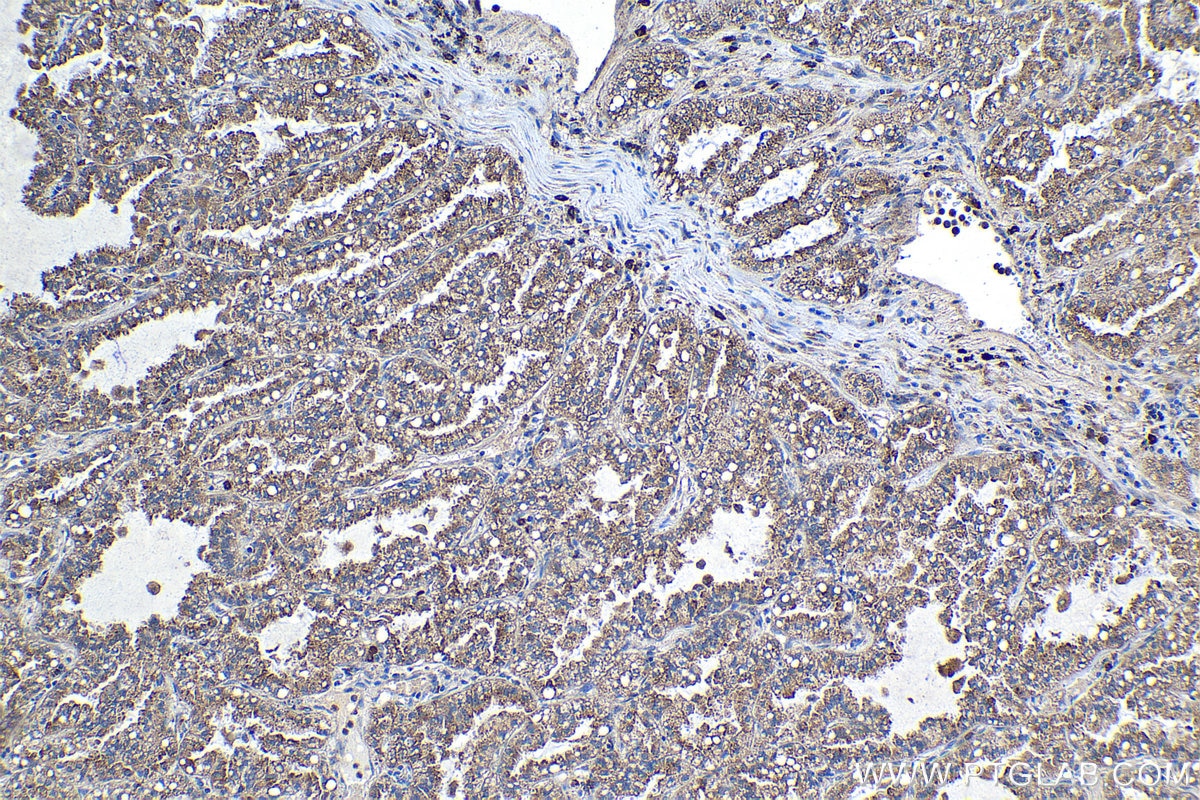 Immunohistochemical analysis of paraffin-embedded human lung cancer tissue slide using KHC1143 (RNASET2 IHC Kit).
