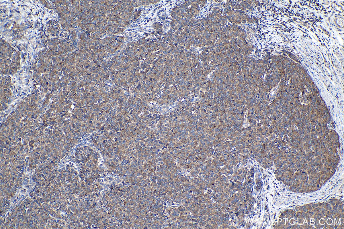 Immunohistochemical analysis of paraffin-embedded human stomach cancer tissue slide using KHC1143 (RNASET2 IHC Kit).