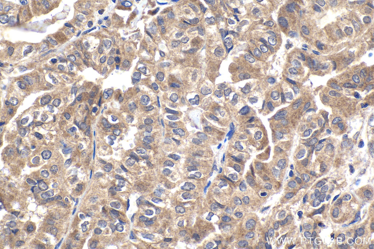 Immunohistochemical analysis of paraffin-embedded human thyroid cancer tissue slide using KHC1831 (RNF10 IHC Kit).