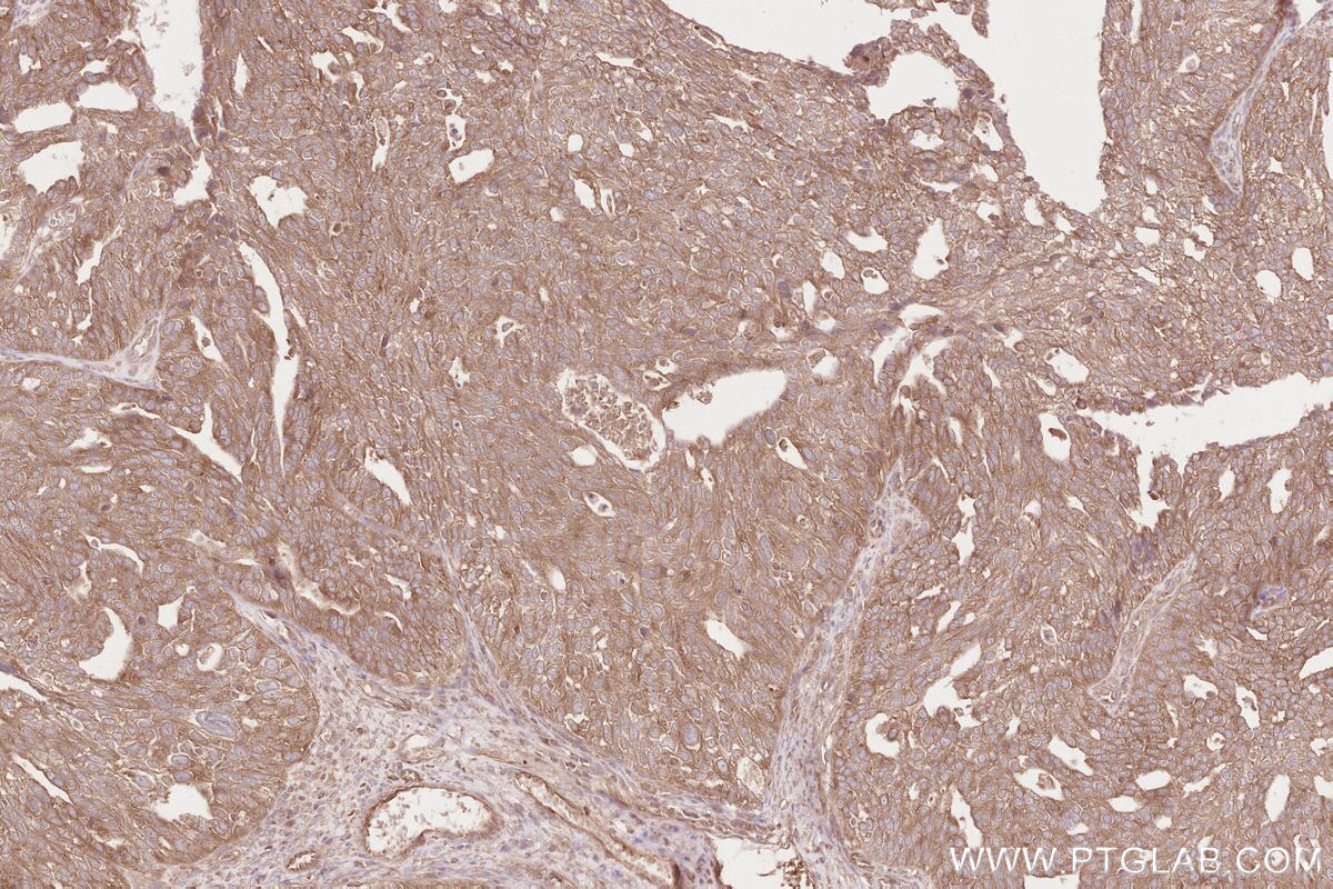 Immunohistochemical analysis of paraffin-embedded human ovary cancer tissue slide using KHC2566 (RNF123 IHC Kit).