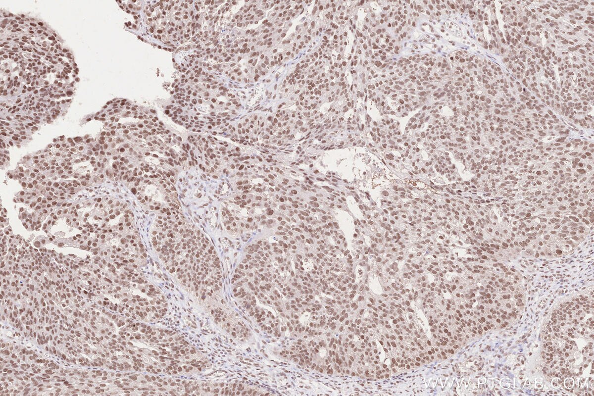 Immunohistochemical analysis of paraffin-embedded human ovary cancer tissue slide using KHC2563 (RNF20 IHC Kit).