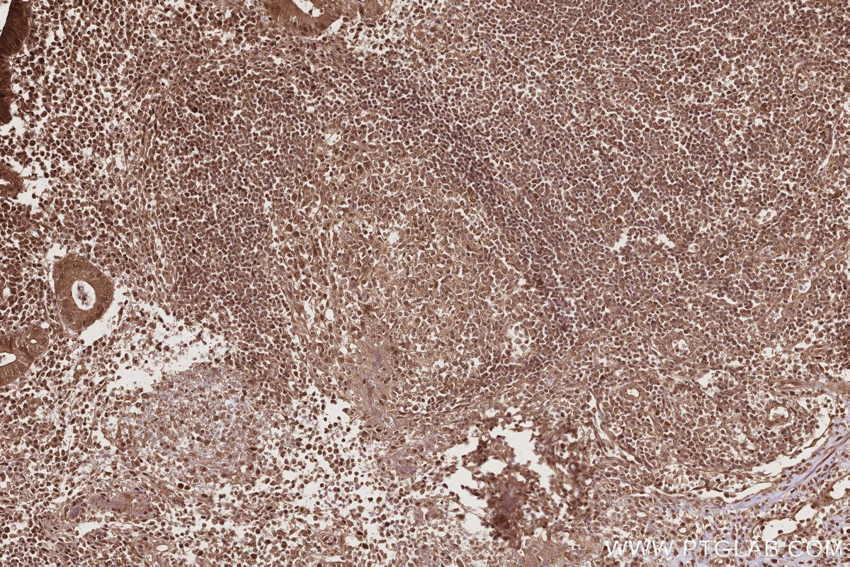 Immunohistochemical analysis of paraffin-embedded human appendicitis tissue slide using KHC2773 (RNF34 IHC Kit).