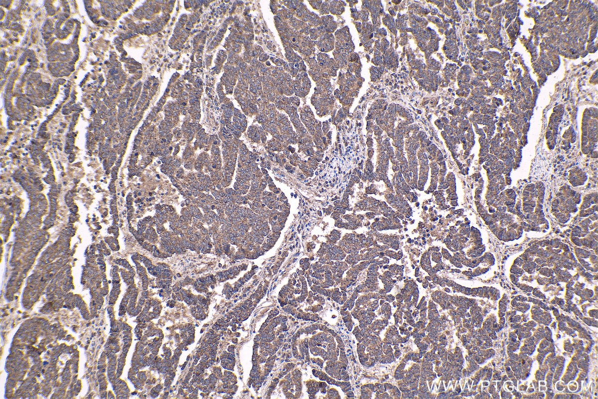 Immunohistochemical analysis of paraffin-embedded human ovary tumor tissue slide using KHC1652 (RNF4 IHC Kit).