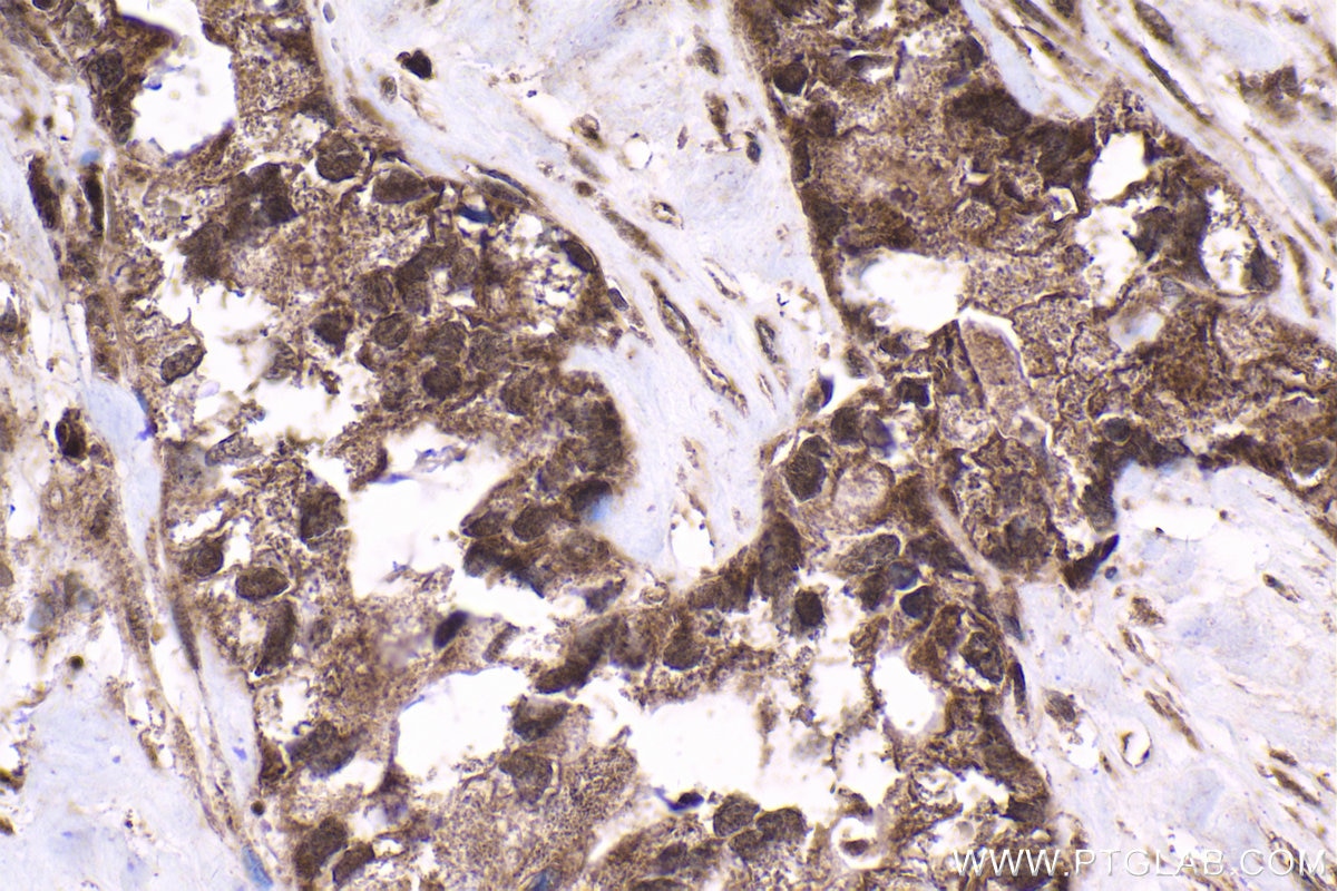 Immunohistochemical analysis of paraffin-embedded human pancreas cancer tissue slide using KHC1652 (RNF4 IHC Kit).