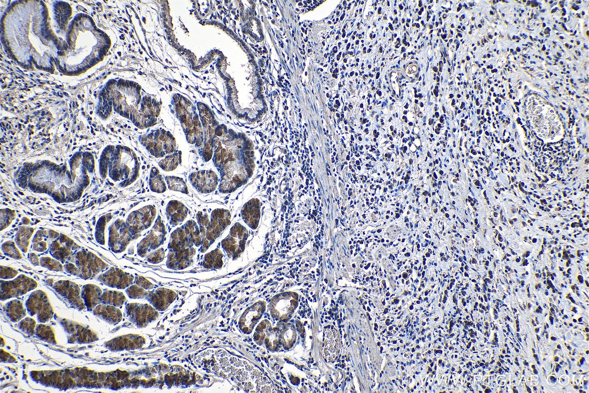 Immunohistochemical analysis of paraffin-embedded human stomach cancer tissue slide using KHC1243 (RNF6 IHC Kit).