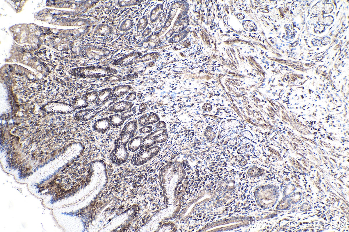 Immunohistochemical analysis of paraffin-embedded human stomach cancer tissue slide using KHC1917 (ROGDI IHC Kit).