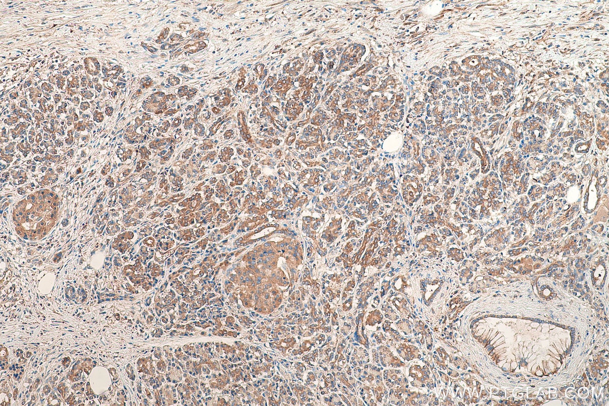 Immunohistochemical analysis of paraffin-embedded human pancreas cancer tissue slide using KHC0819 (ROR1 IHC Kit).
