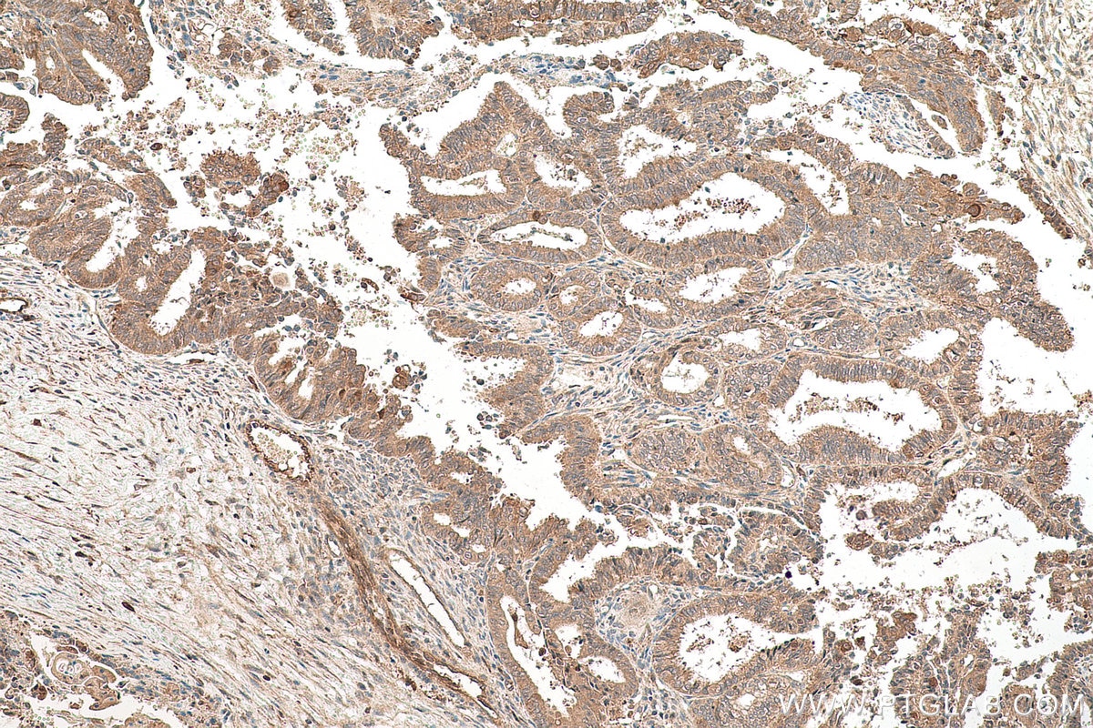 Immunohistochemical analysis of paraffin-embedded human ovary tumor tissue slide using KHC0819 (ROR1 IHC Kit).