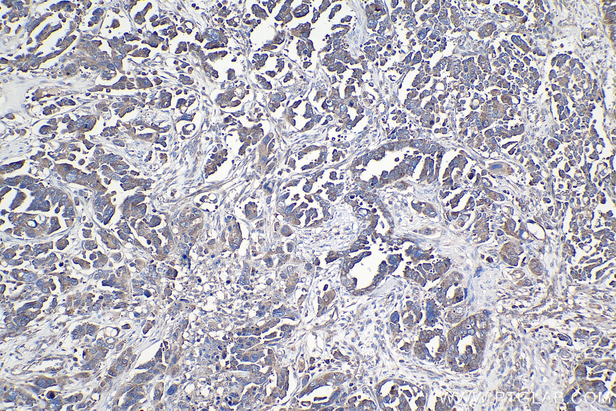 Immunohistochemical analysis of paraffin-embedded human colon cancer tissue slide using KHC0997 (RPAP3 IHC Kit).