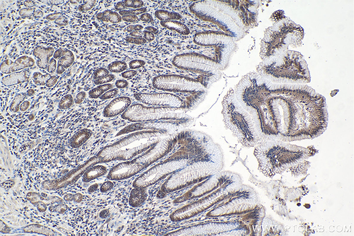 Immunohistochemical analysis of paraffin-embedded human stomach cancer tissue slide using KHC0997 (RPAP3 IHC Kit).
