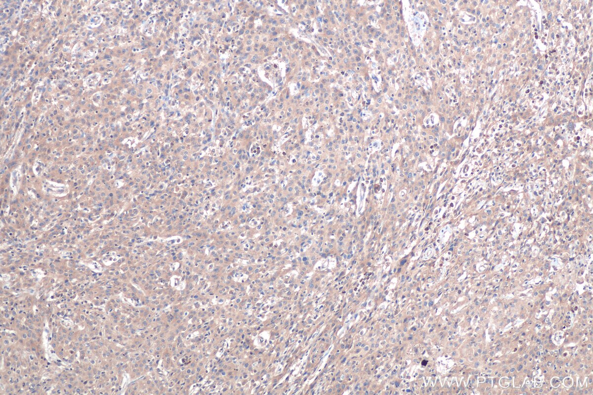 Immunohistochemical analysis of paraffin-embedded human cervical cancer tissue slide using KHC0900 (RPL13 IHC Kit).