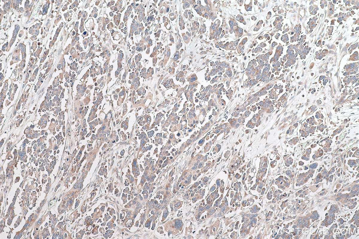 Immunohistochemical analysis of paraffin-embedded human colon cancer tissue slide using KHC0900 (RPL13 IHC Kit).