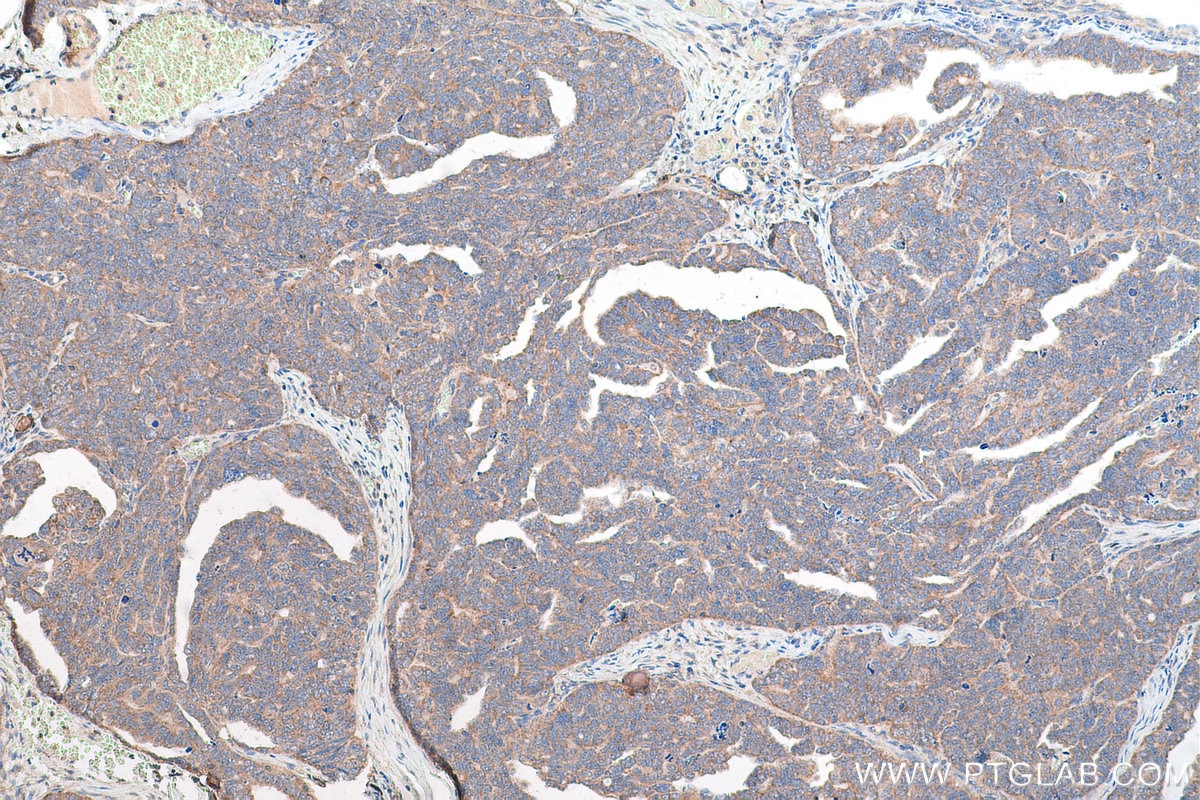 Immunohistochemical analysis of paraffin-embedded human ovary tumor tissue slide using KHC0900 (RPL13 IHC Kit).