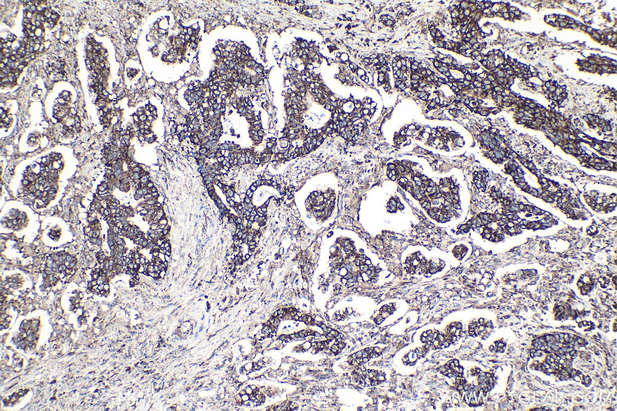 Immunohistochemical analysis of paraffin-embedded human stomach cancer tissue slide using KHC1372 (RPL14 IHC Kit).