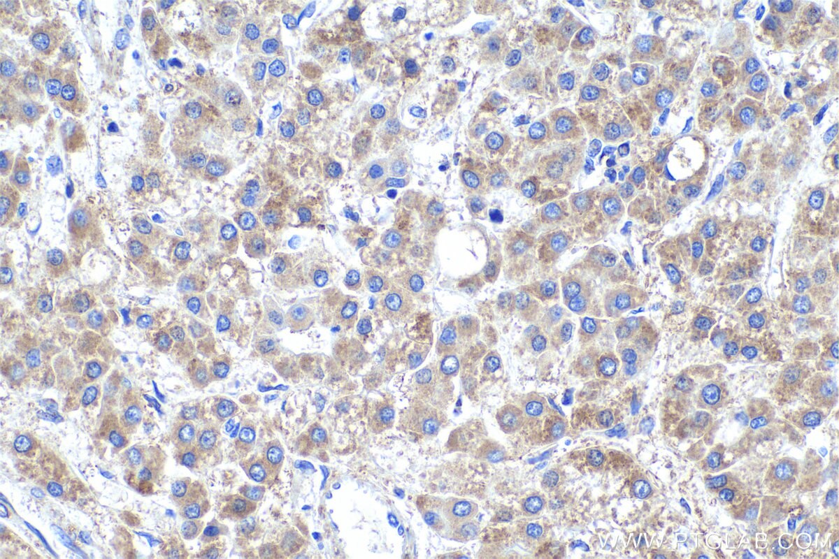 Immunohistochemical analysis of paraffin-embedded human liver cancer tissue slide using KHC0914 (RPL21 IHC Kit).