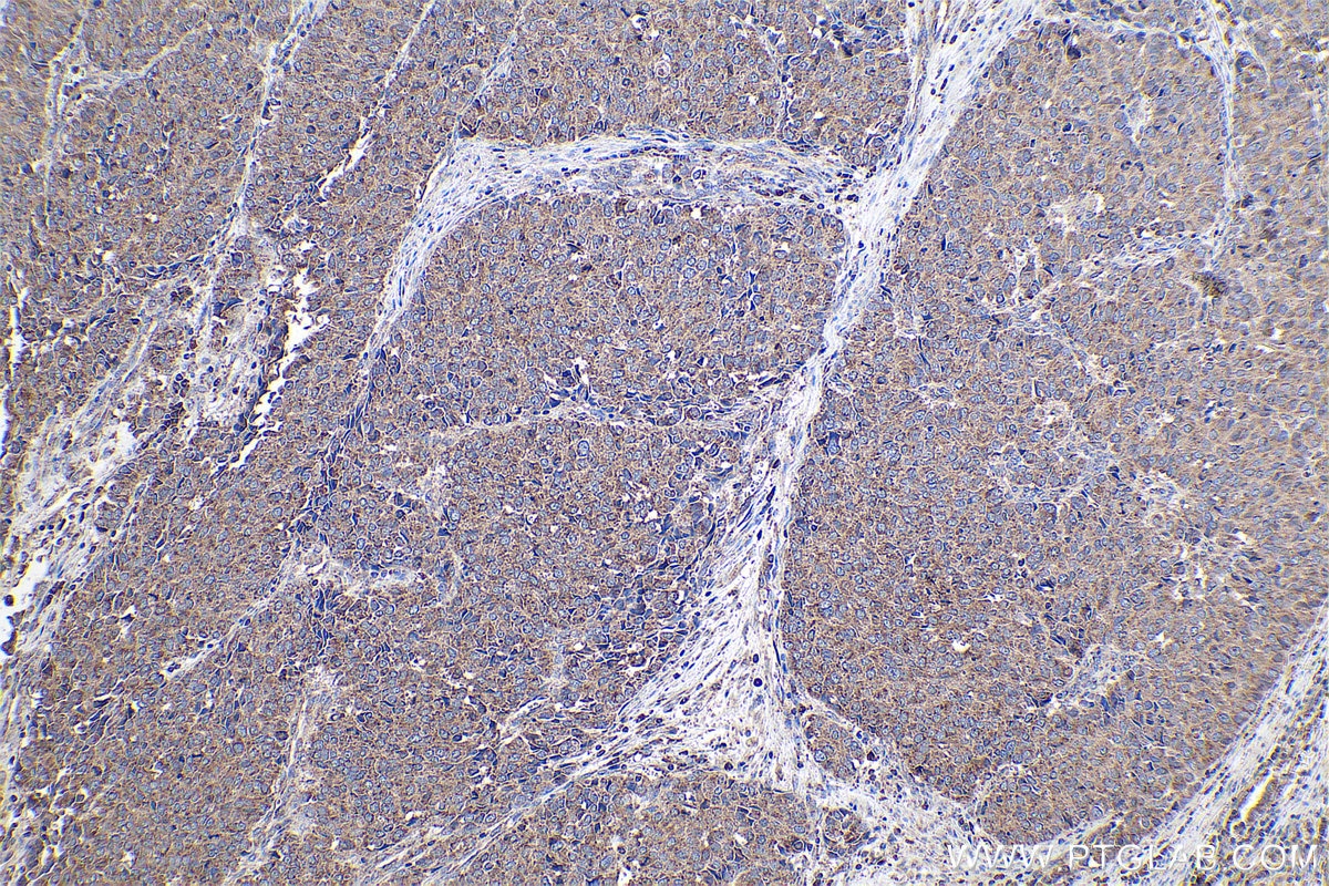 Immunohistochemical analysis of paraffin-embedded human stomach cancer tissue slide using KHC0914 (RPL21 IHC Kit).