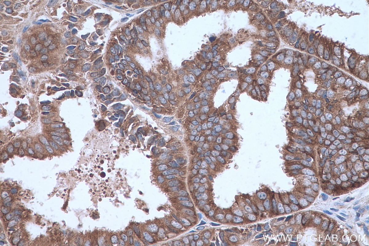 Immunohistochemical analysis of paraffin-embedded human ovary tumor tissue slide using KHC0639 (RPL23 IHC Kit).