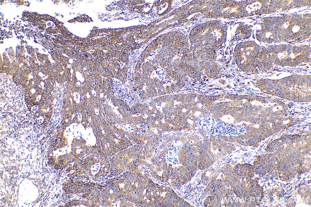 Immunohistochemical analysis of paraffin-embedded human colon cancer tissue slide using KHC0583 (RPL23A IHC Kit).