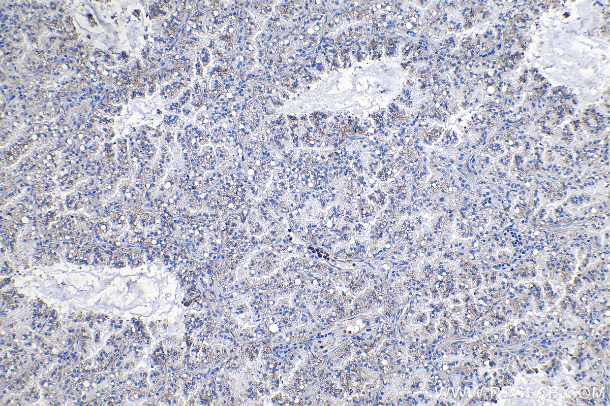 Immunohistochemical analysis of paraffin-embedded human lung cancer tissue slide using KHC1144 (RPL31 IHC Kit).