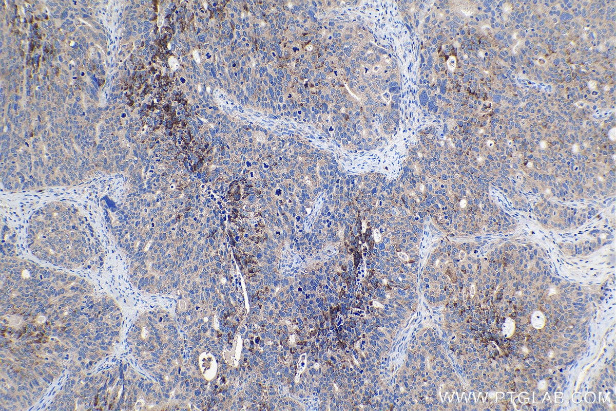 Immunohistochemical analysis of paraffin-embedded human ovary tumor tissue slide using KHC1144 (RPL31 IHC Kit).