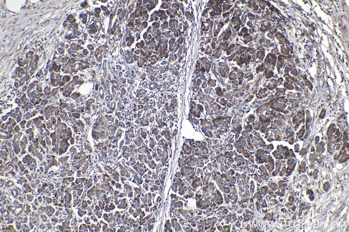 Immunohistochemical analysis of paraffin-embedded human pancreas cancer tissue slide using KHC1144 (RPL31 IHC Kit).