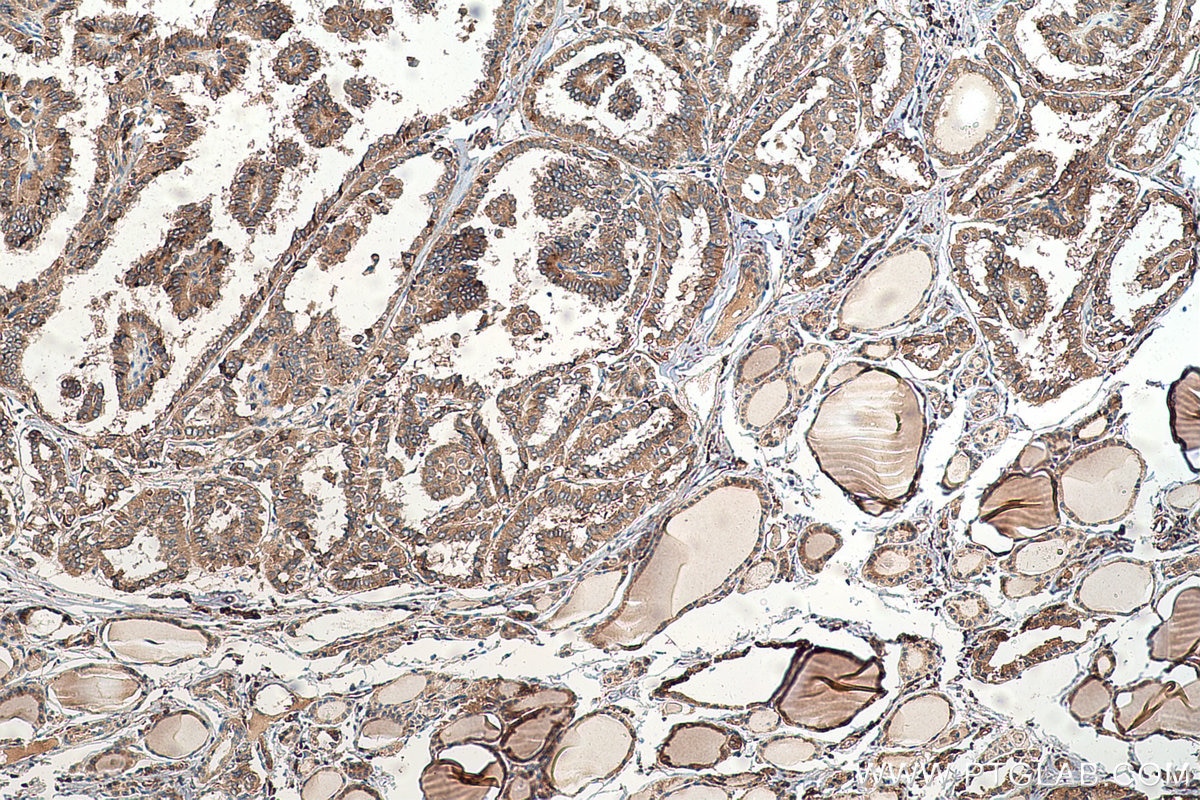 Immunohistochemical analysis of paraffin-embedded human thyroid cancer tissue slide using KHC0586 (RPL35 IHC Kit).